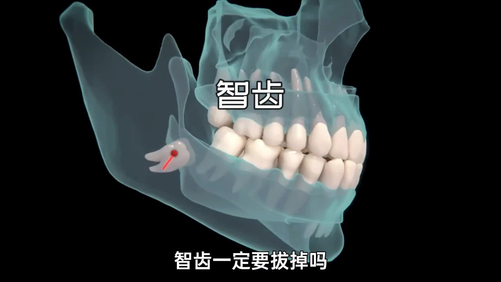 智齿在哪里需要拔掉吗