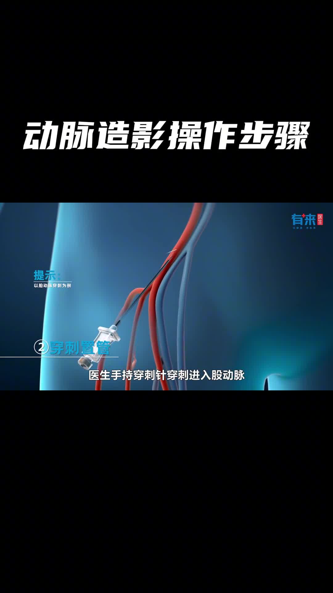 动脉造影是如何做的