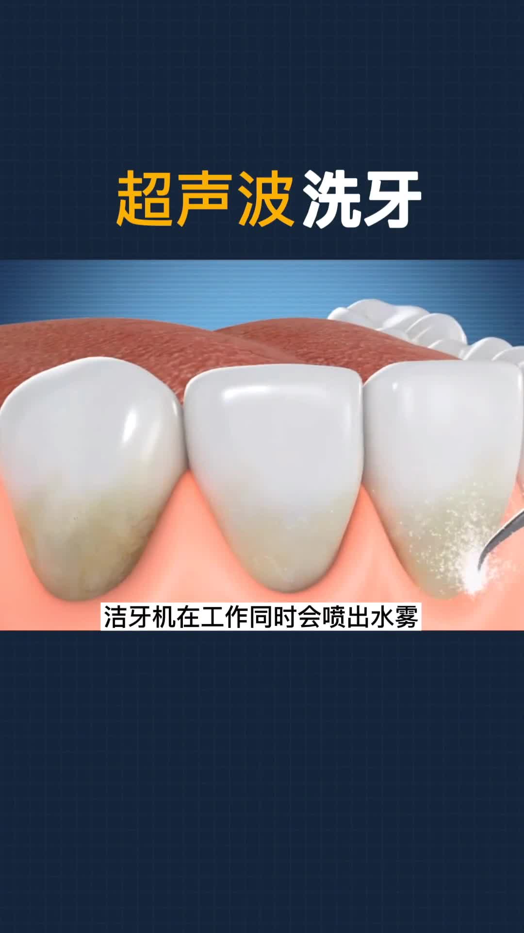 洗牙到底好不好呢