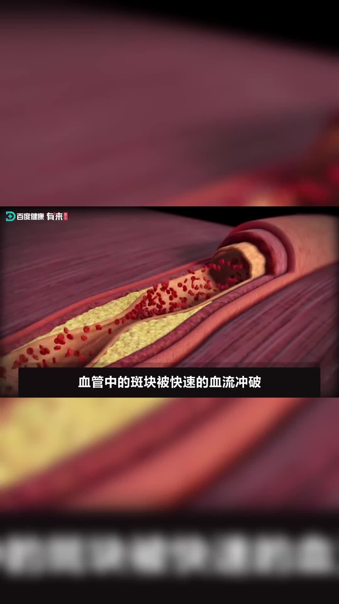 堵塞的血管是如何造成心肌梗si的