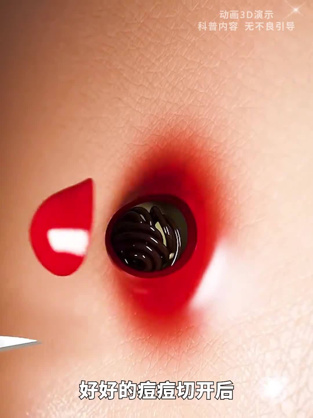 头发是如何钻进皮肤里的