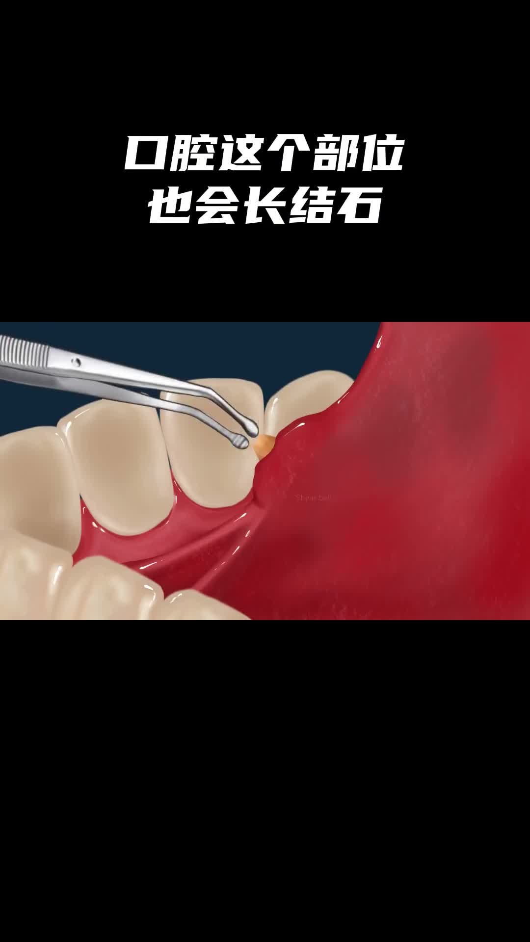 你见过这个部位的结石吗