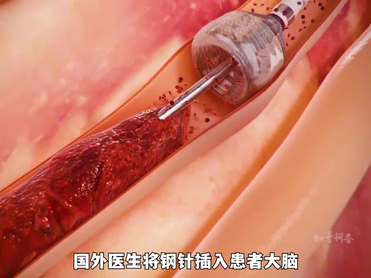 国外消除血栓的机器两分钟就能清除干净