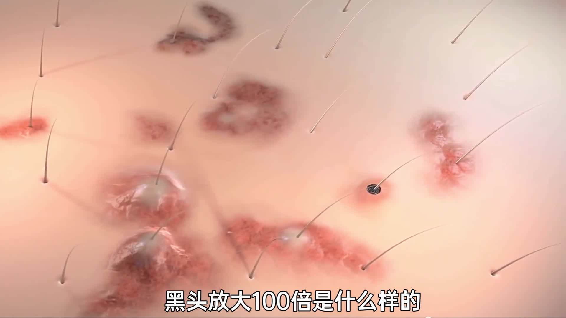 如何清理黑头教大家一个小方法