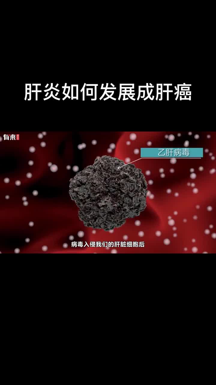 肝癌3步曲一定要看到最后