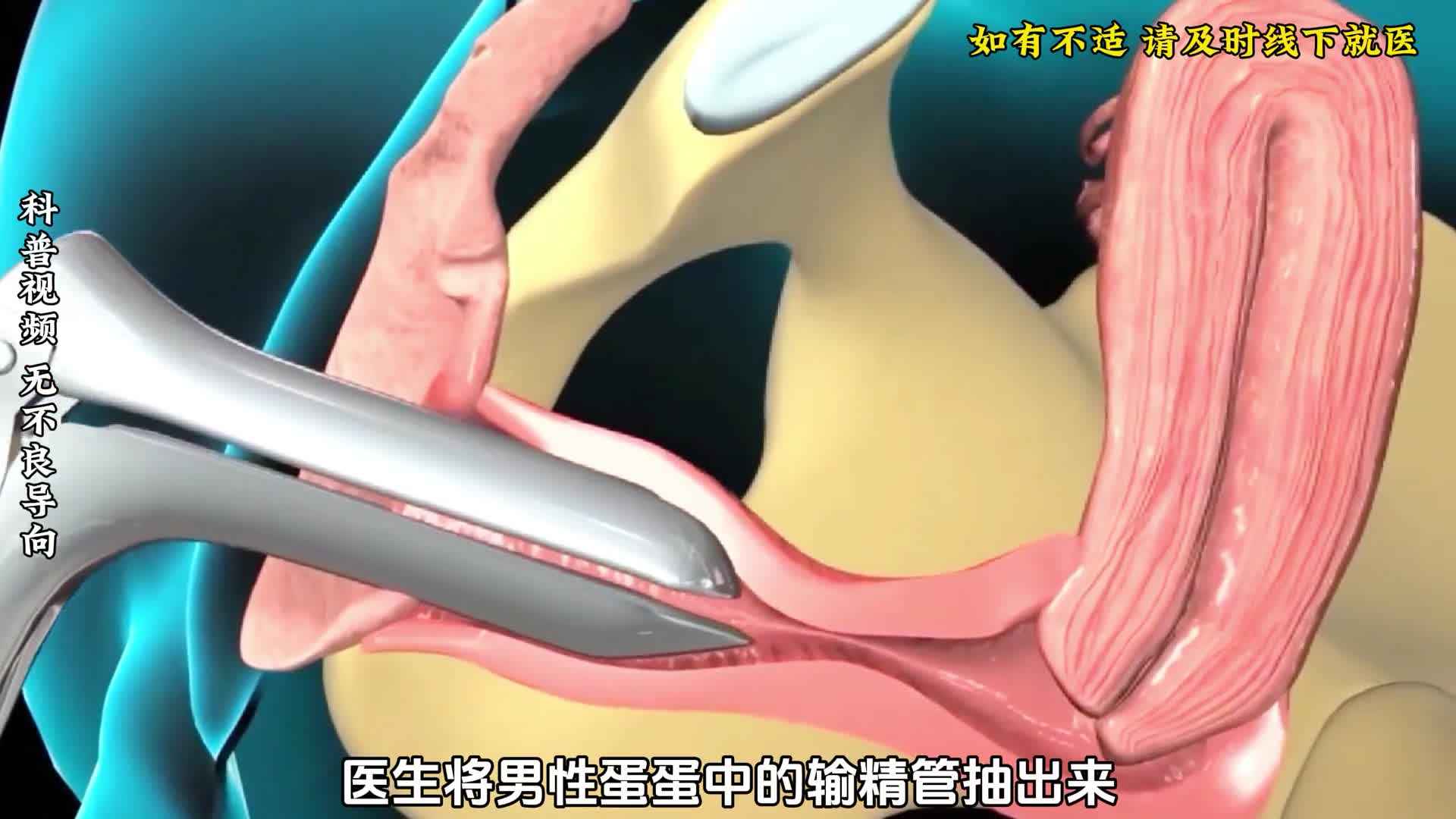 男性结扎手术3D动画全过程一段神奇而又复杂的旅程