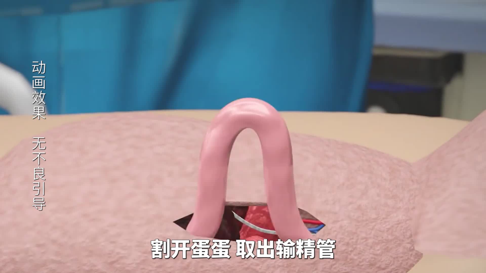 什么是结扎男女结扎又有何不同