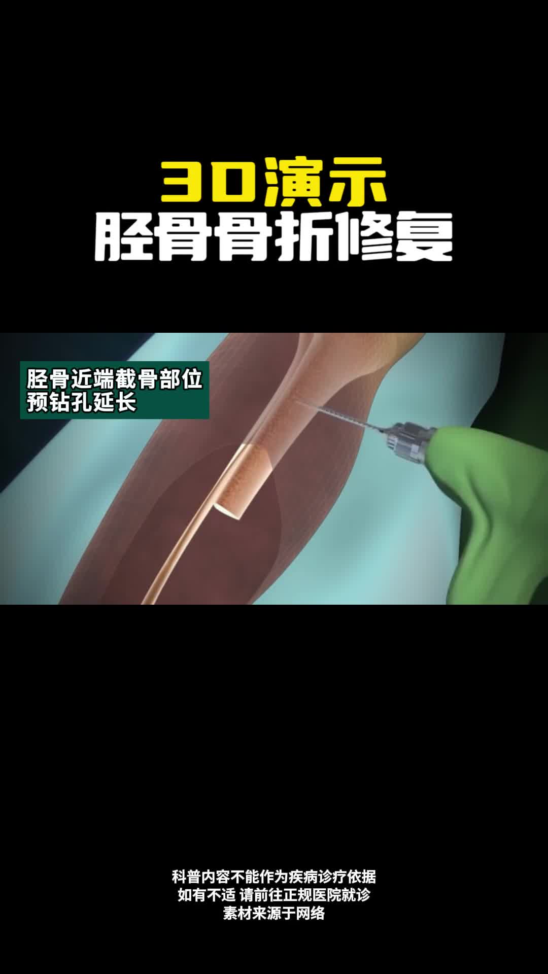 3D演示胫骨骨折修复