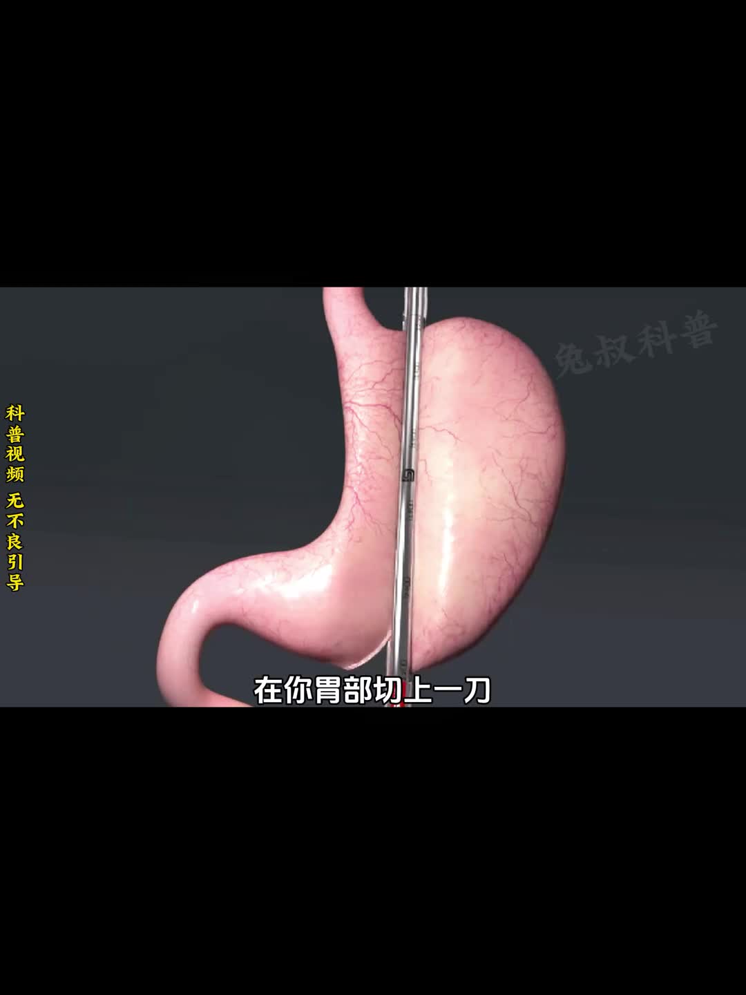 3D动画演绎胃切手术全过程