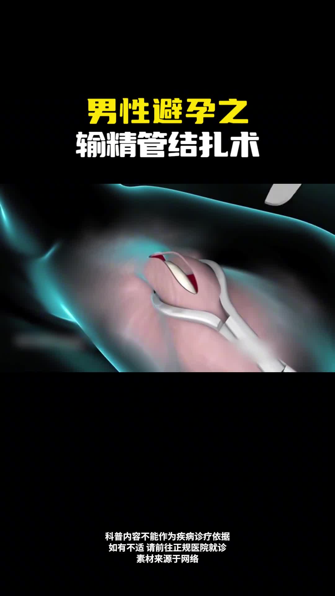 男性避孕之输精管结扎术