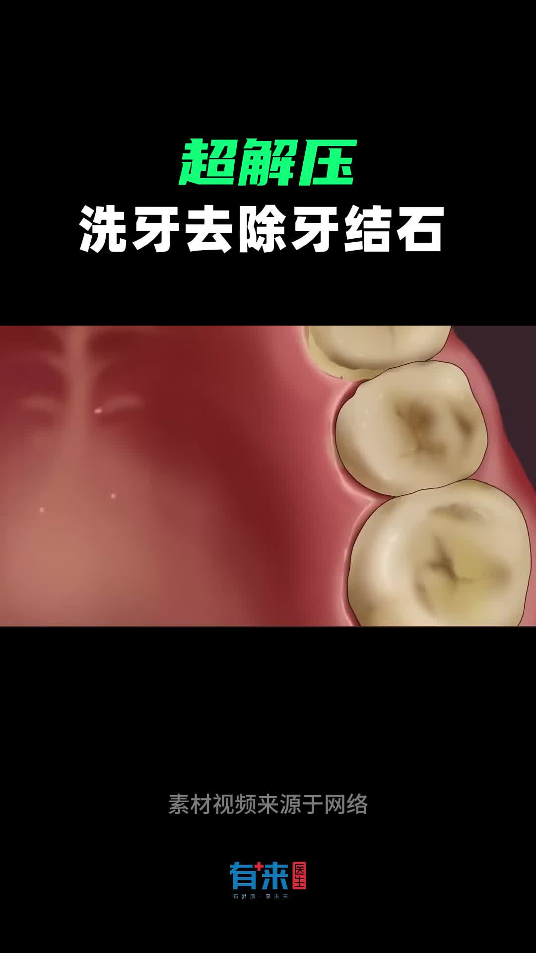 超解压沉浸式洗牙