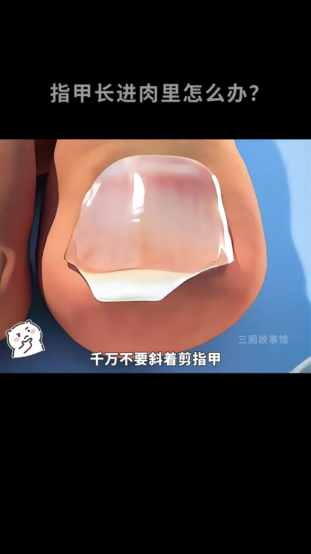 脚指甲长进肉里怎么办