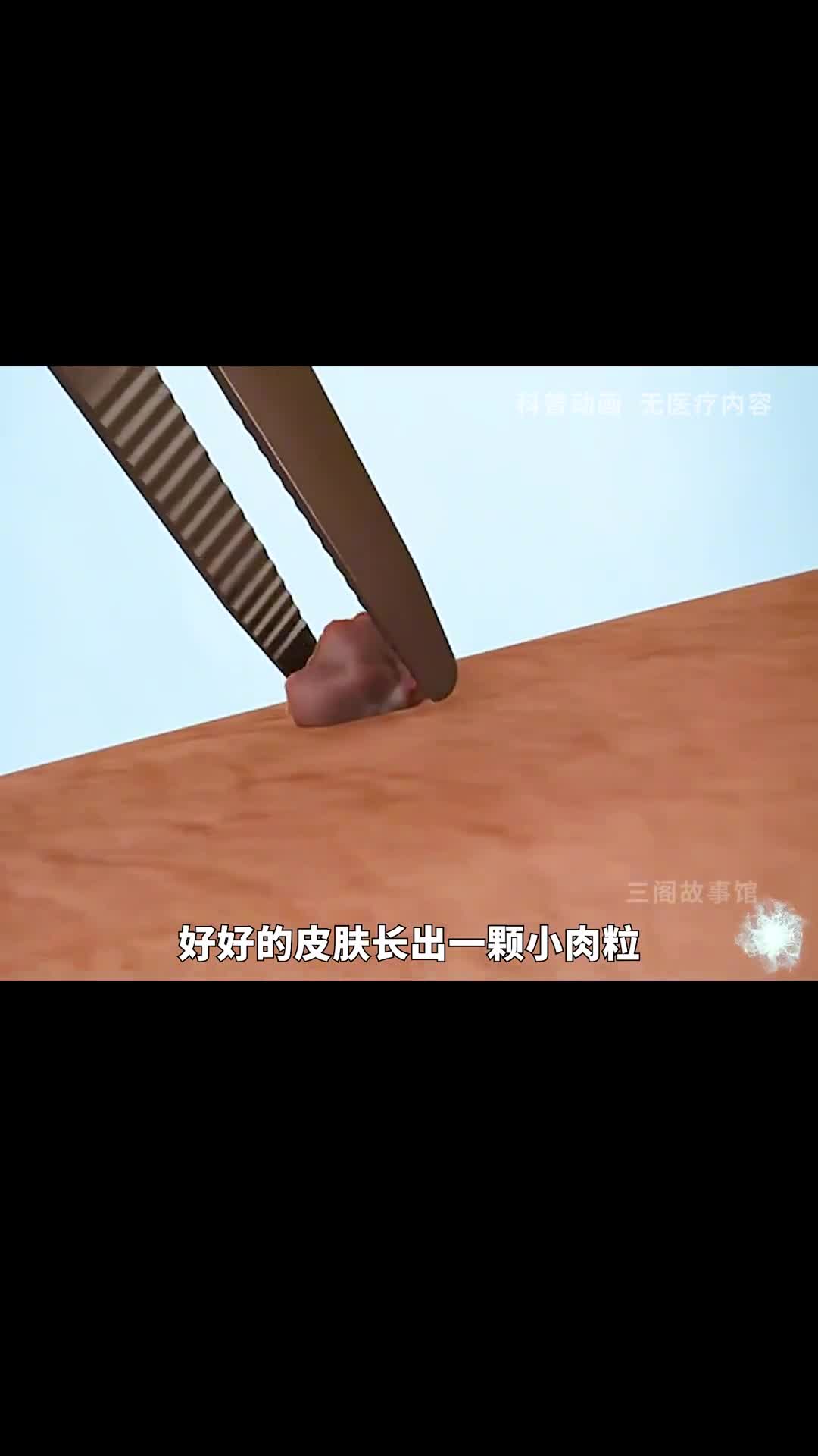 长出这样的小肉粒千万不要自己拔除