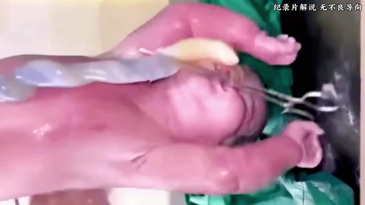 宝宝刚出生就没有了呼吸和心跳抢救过程让人既揪心又感动