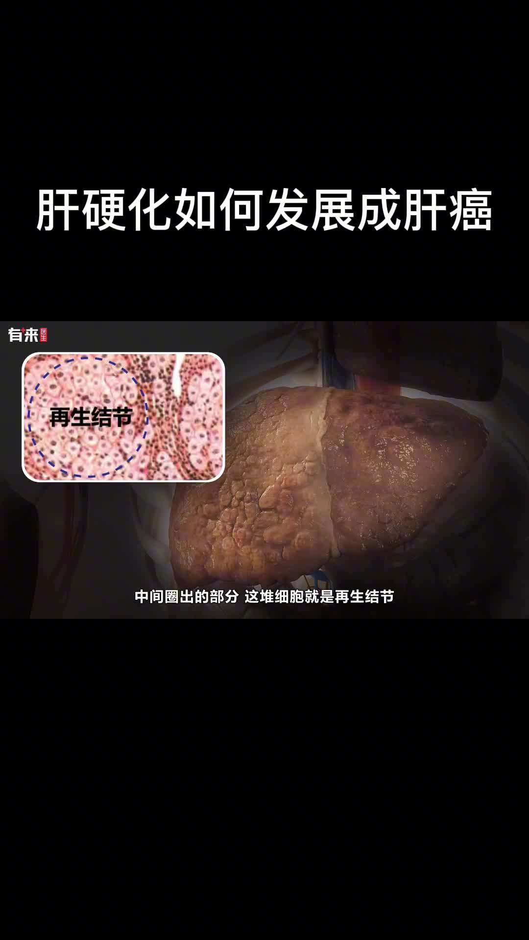 肝硬化后我们的肝脏会变成什么样