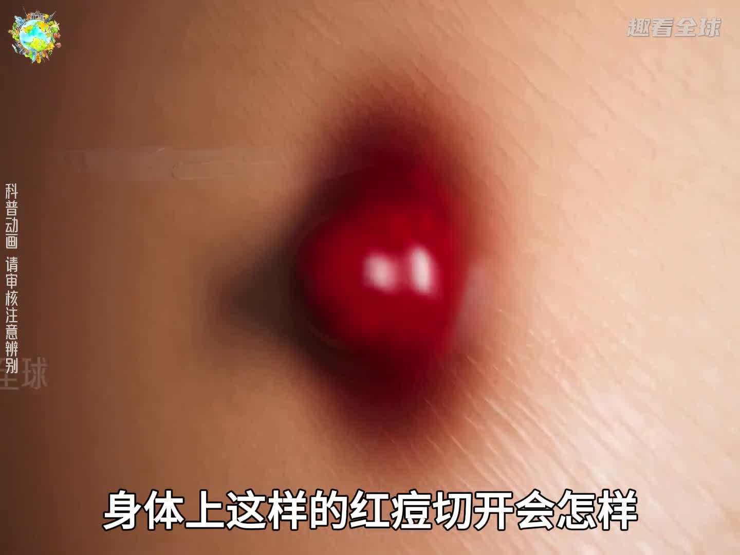身体上的红痘切开是怎样的