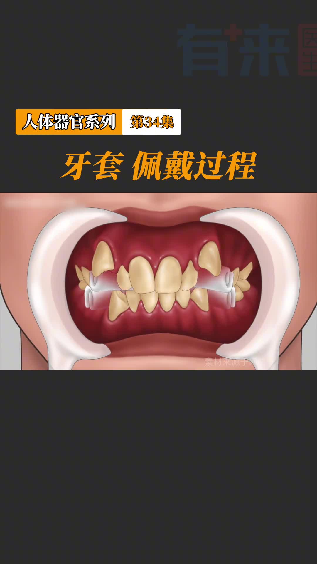 牙套真的好强大