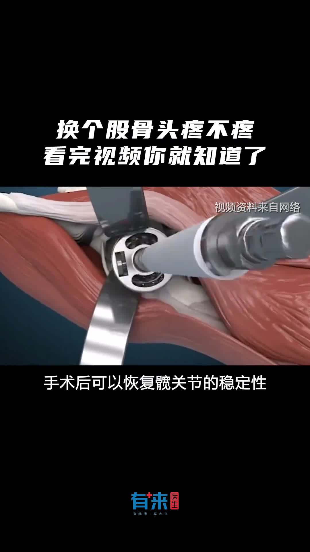 换个股骨头到底疼不疼看完视频你就知道了