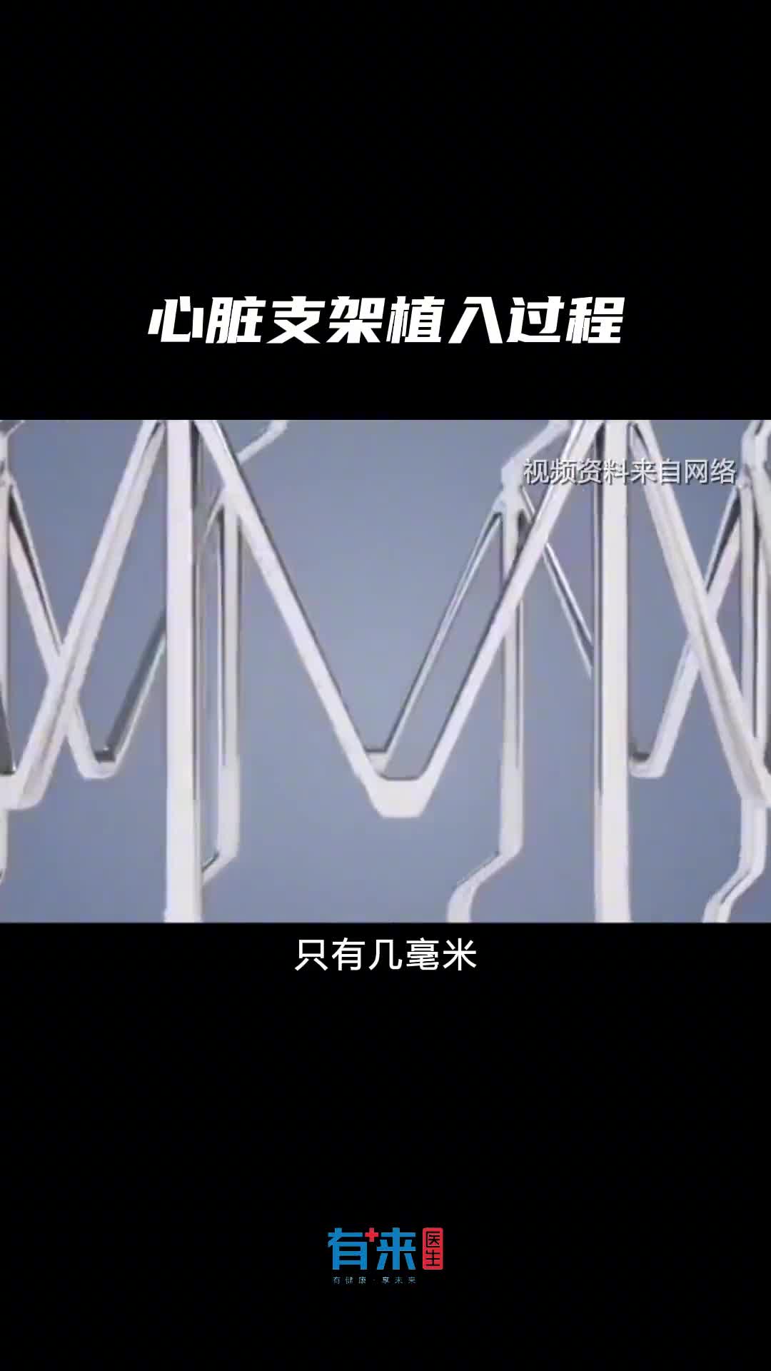 一个视频让你看懂心脏支架