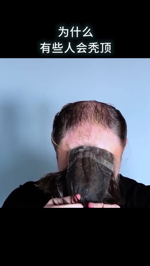 为什么有些人会秃顶