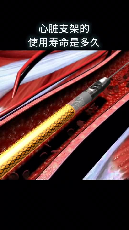 心脏支架的使用寿命是多久