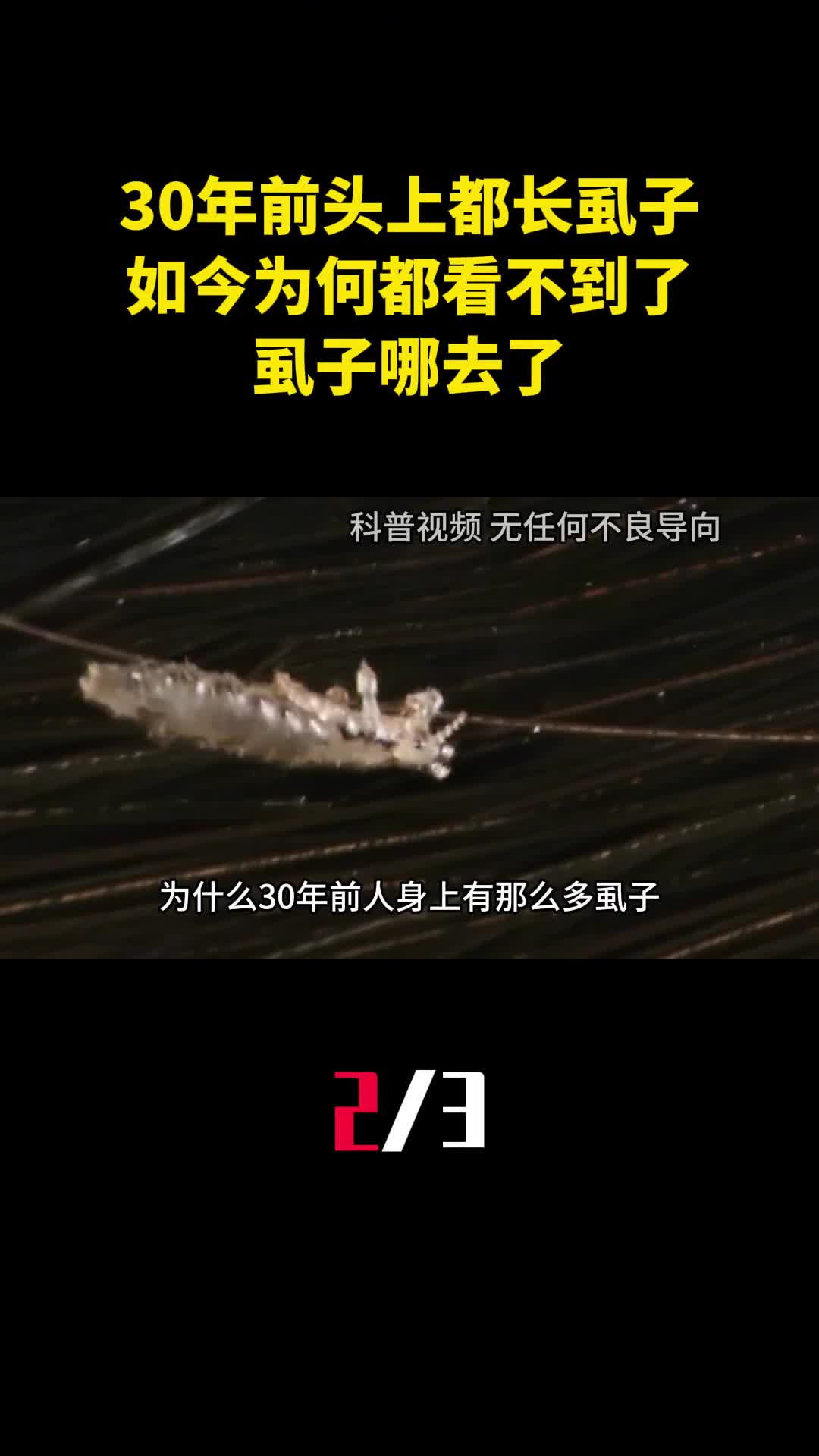 30年前农村人人头上都长虱子如今为何都看不到了虱子哪去了2