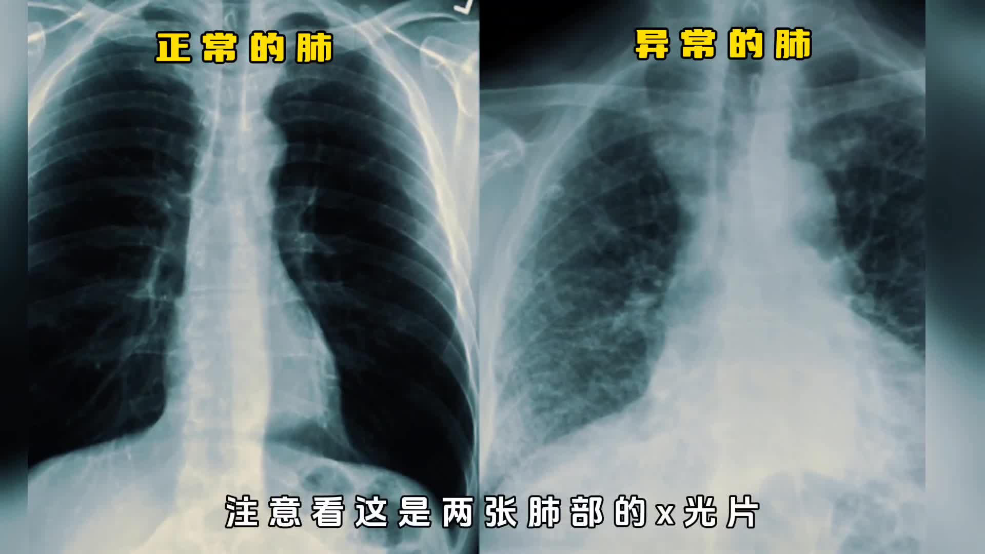 两张肺部的X光片揭露石棉的危害究竟有多大