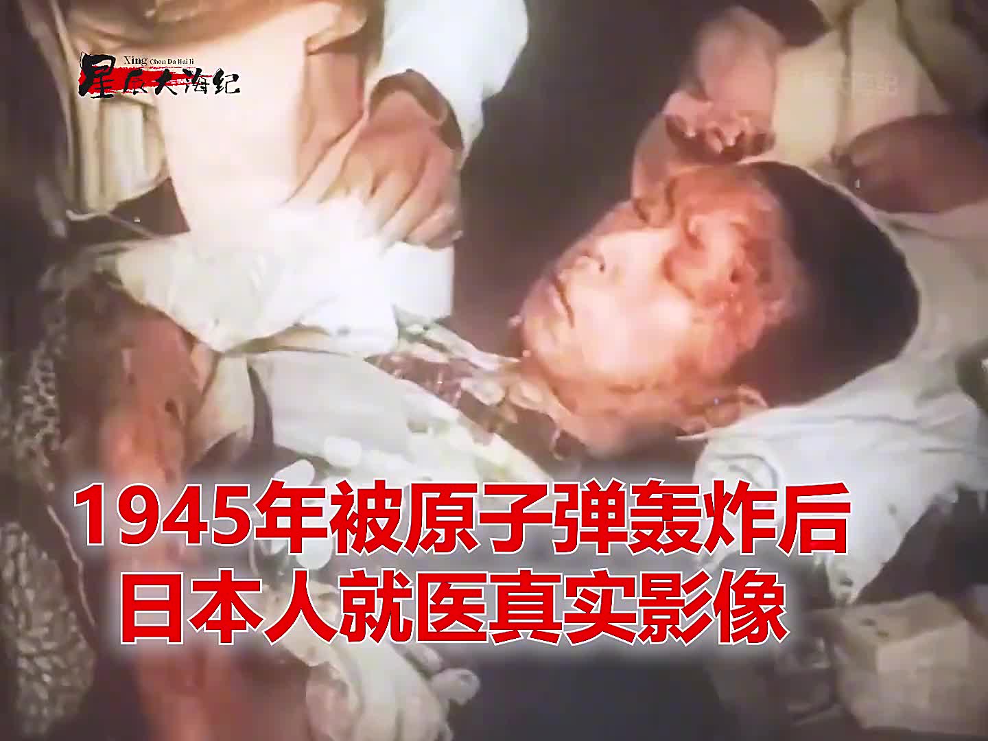 1945年被原子弹轰炸后日本真实影像皮肤被烧焦残肢断臂1945年被原子弹轰炸后日本真实影像皮肤被烧焦残肢断臂如同外星人