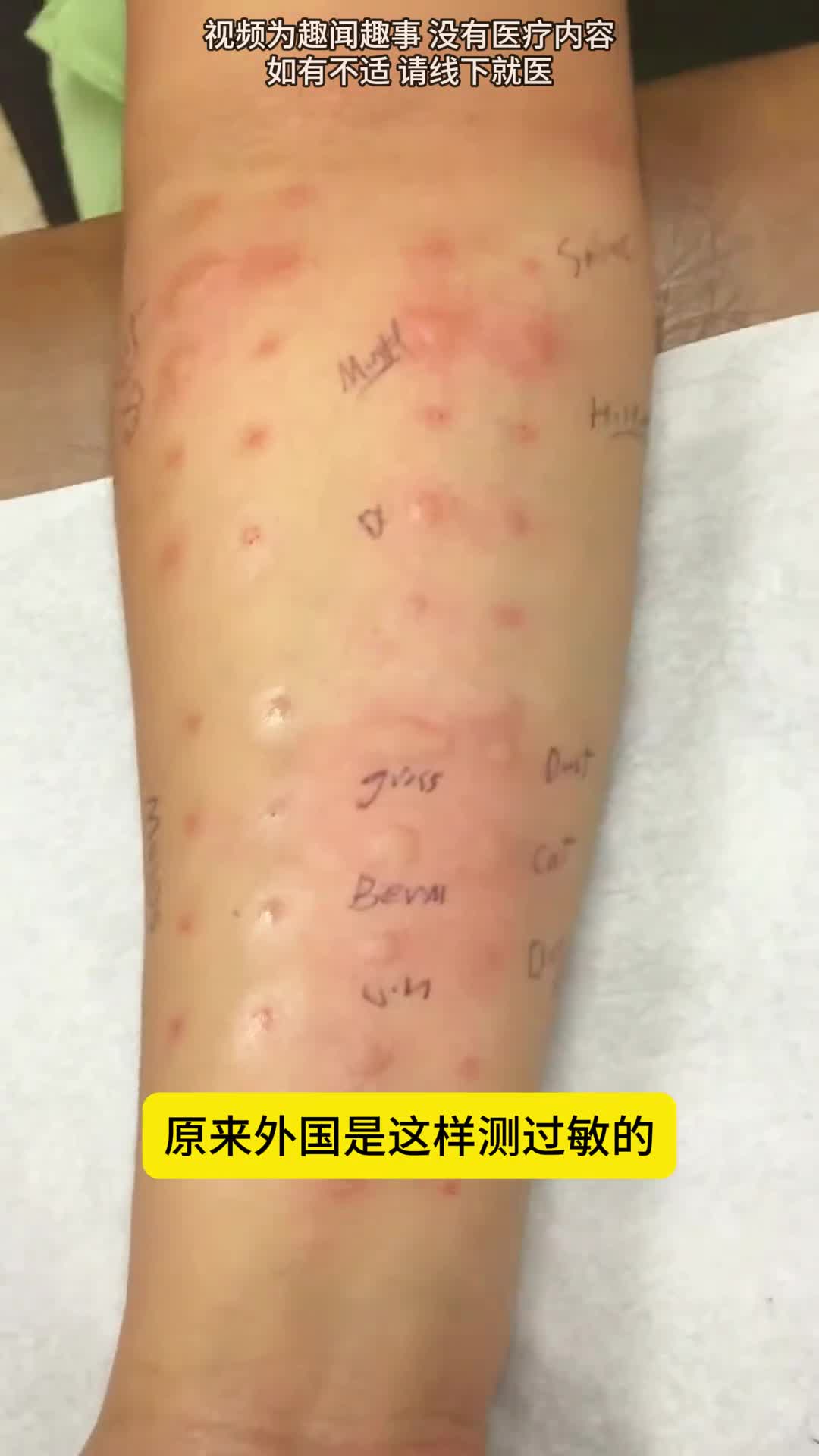 原来国外这样测过敏