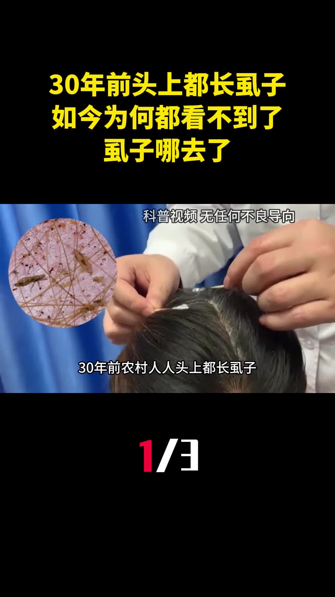 30年前农村人人头上都长虱子如今为何都看不到了虱子哪去了1