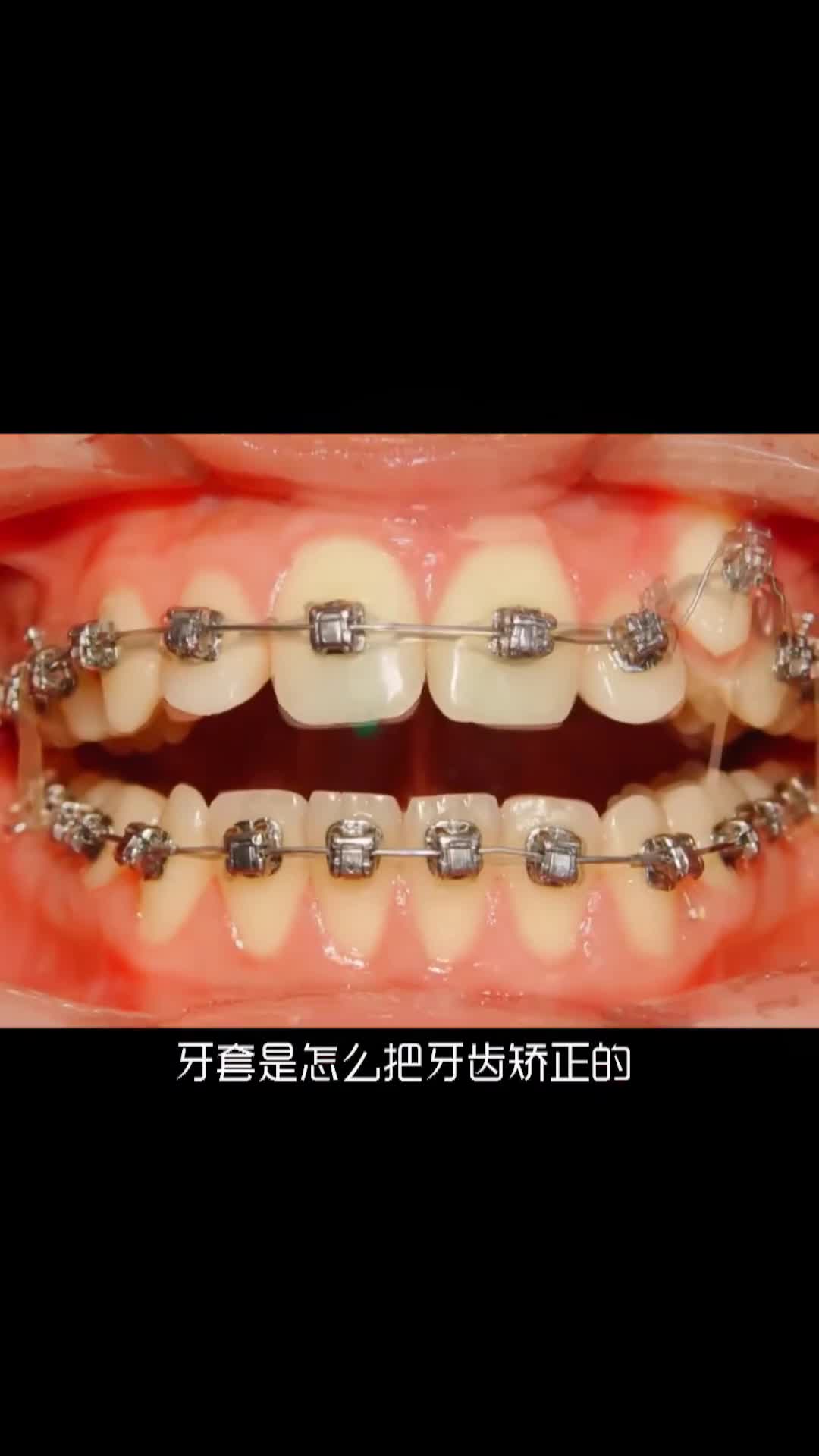 牙套是怎么矫正牙齿的