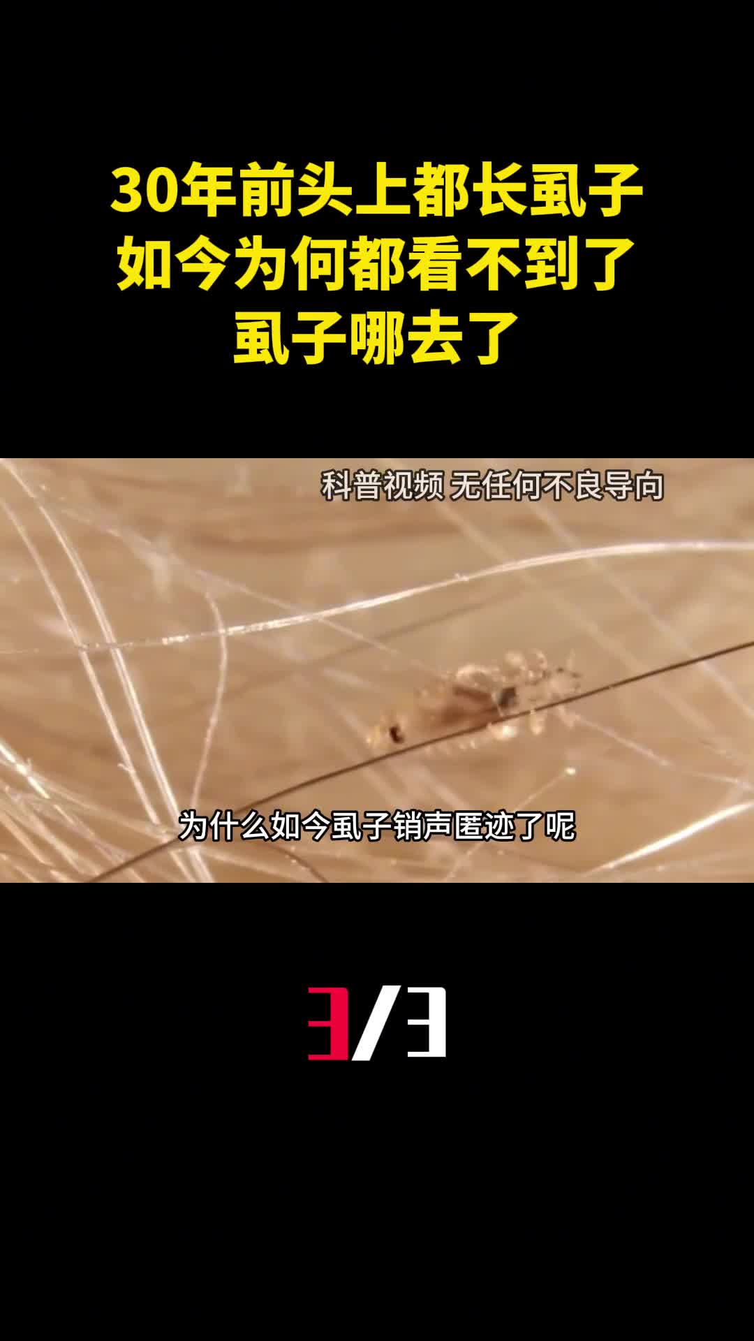 30年前农村人人头上都长虱子如今为何都看不到了虱子哪去了3
