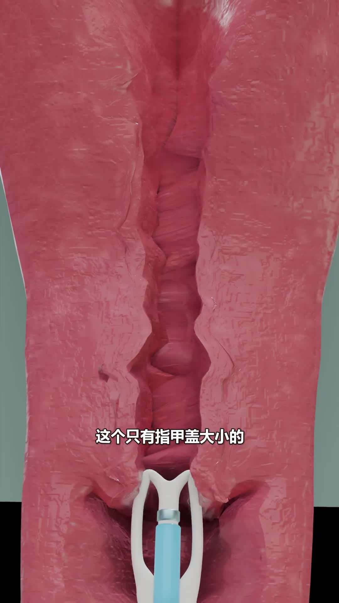 节育环的工作原理