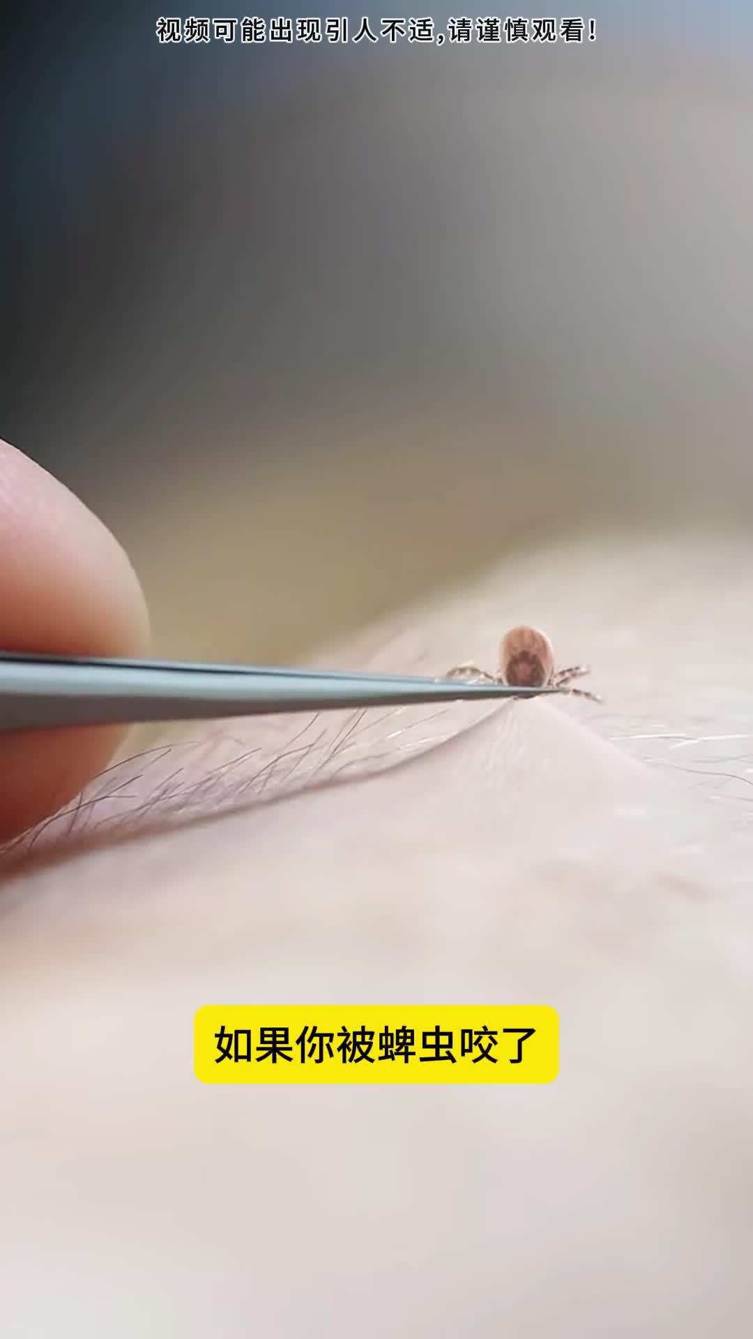 如果你被蜱虫咬了千万不能用手拔