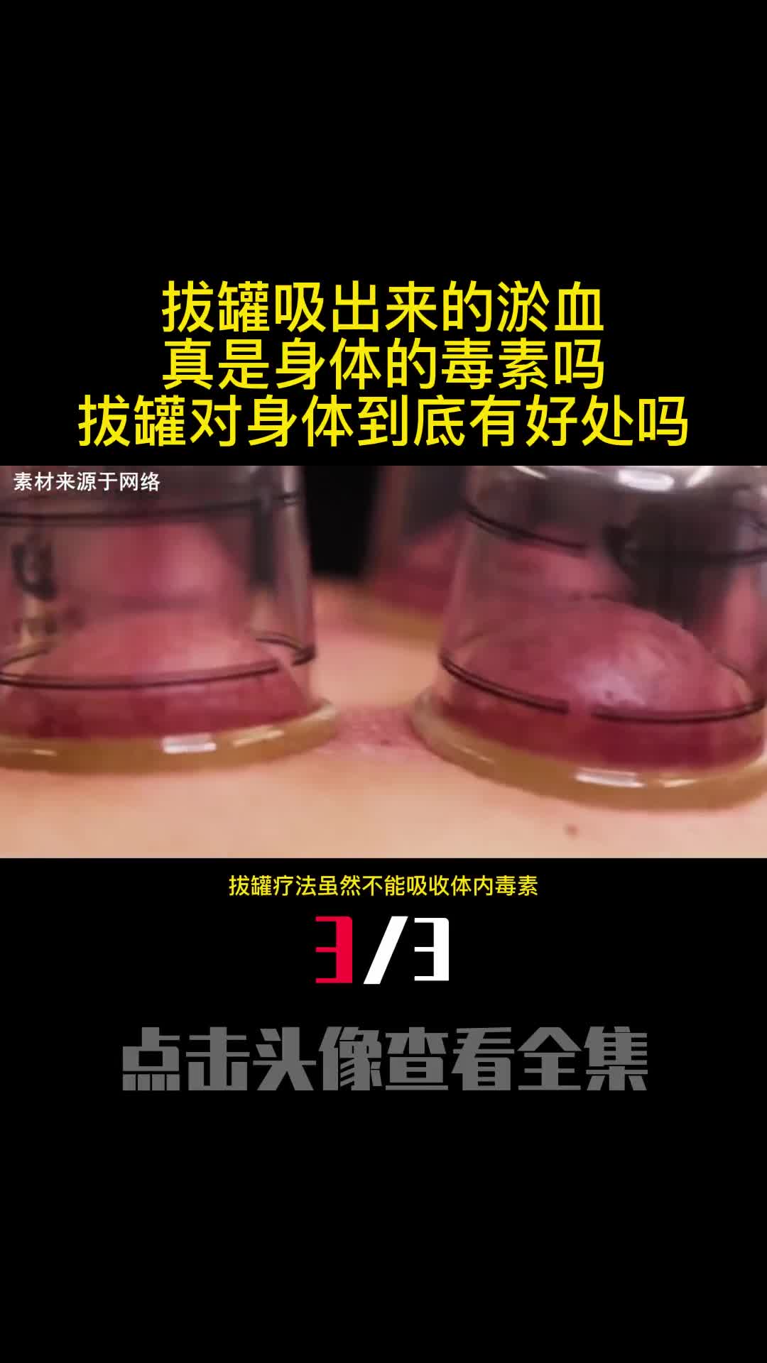 拔罐吸出来的淤血真是身体的毒素吗拔罐对身体到底有好处吗3