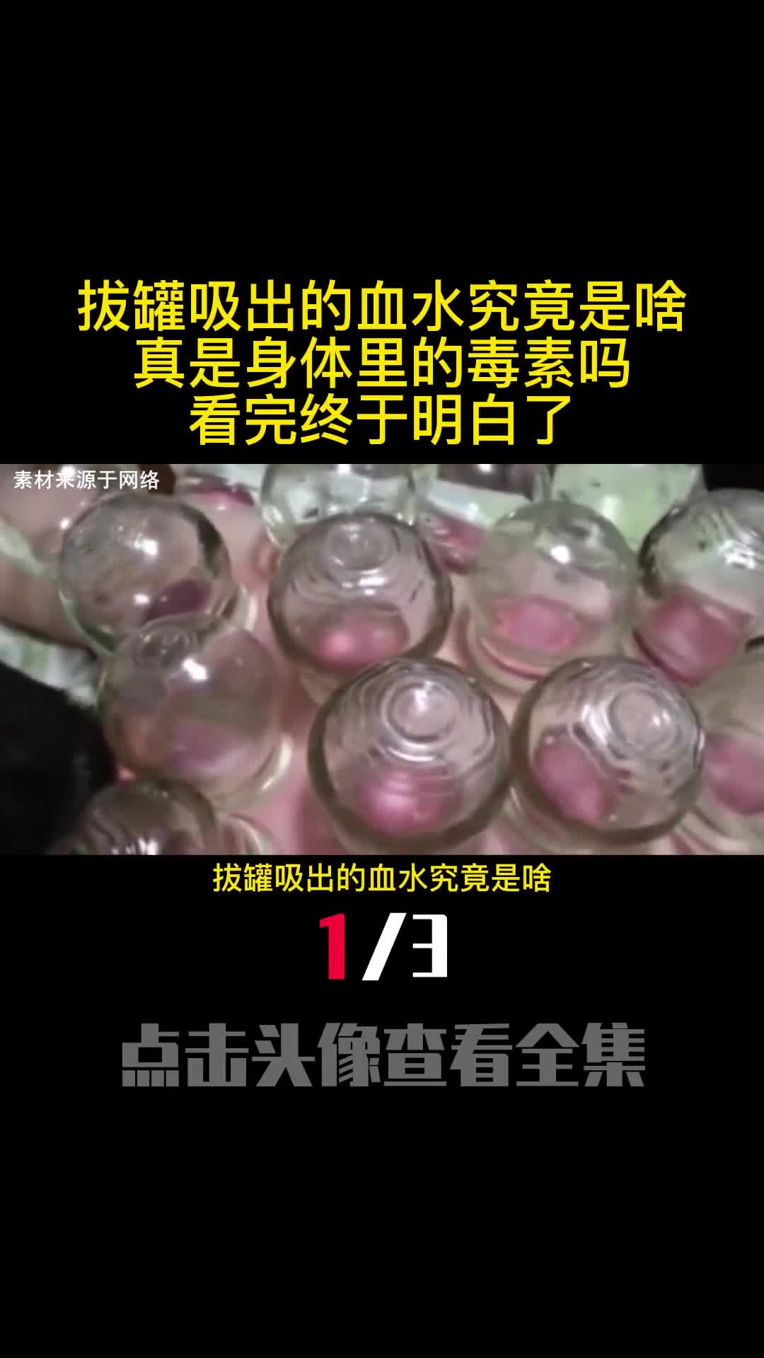 拔罐吸出的血水究竟是啥真是身体里的毒素吗看完终于明白了1