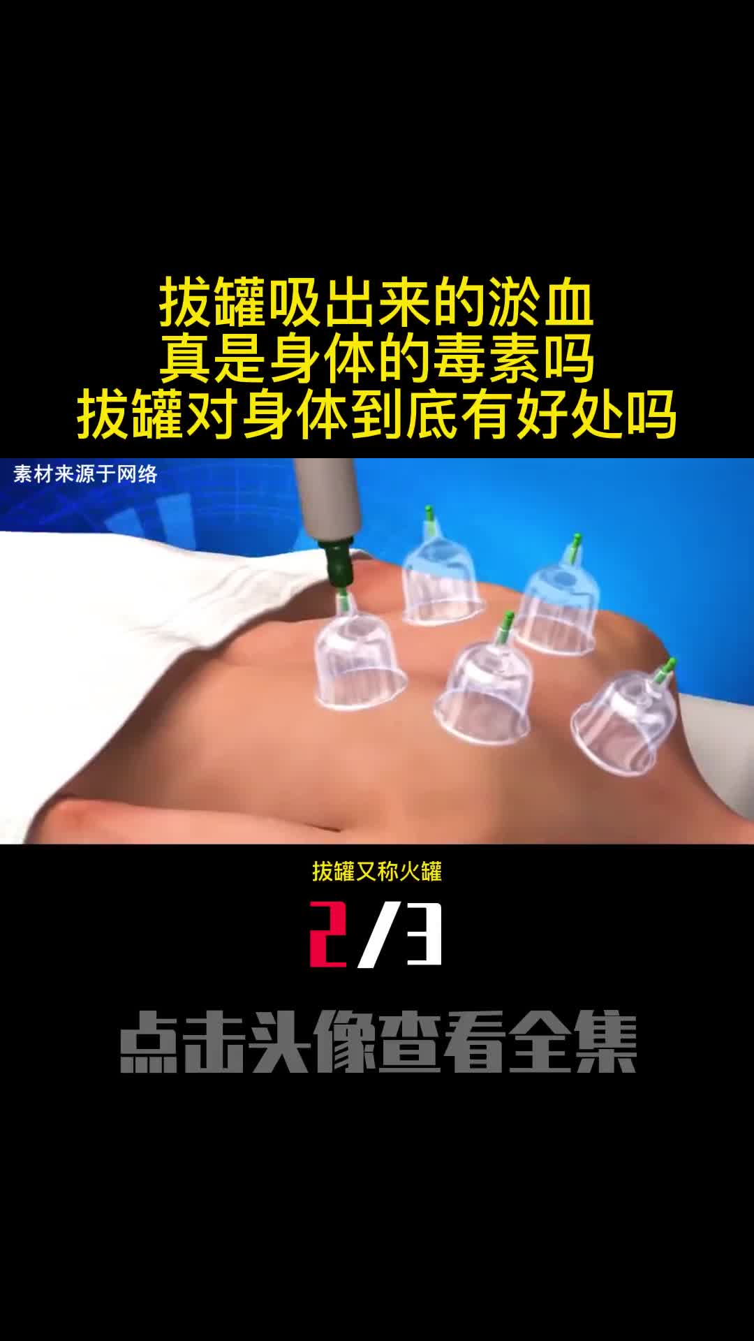 拔罐吸出来的淤血真是身体的毒素吗拔罐对身体到底有好处吗2
