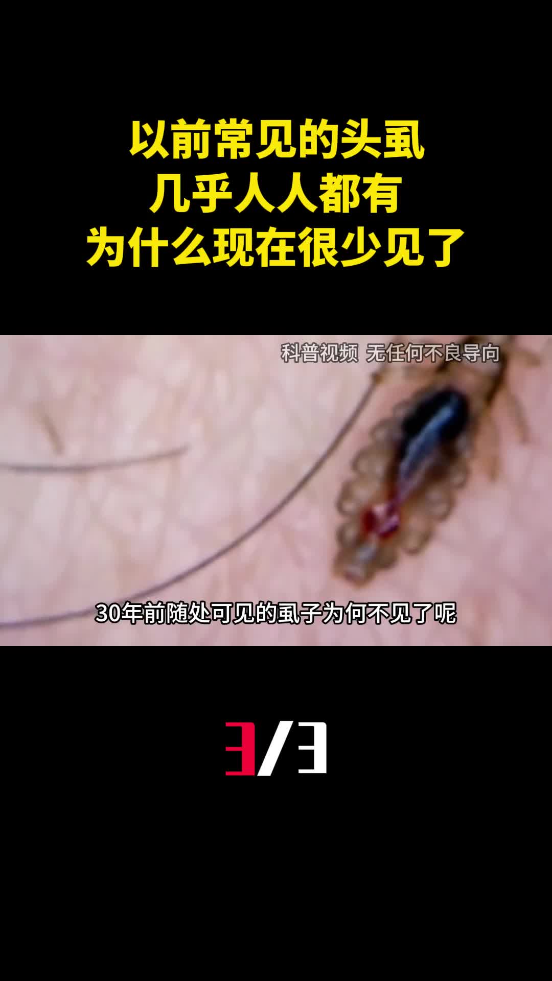 以前常见的头虱几乎人人都有为什么现在很少见了3