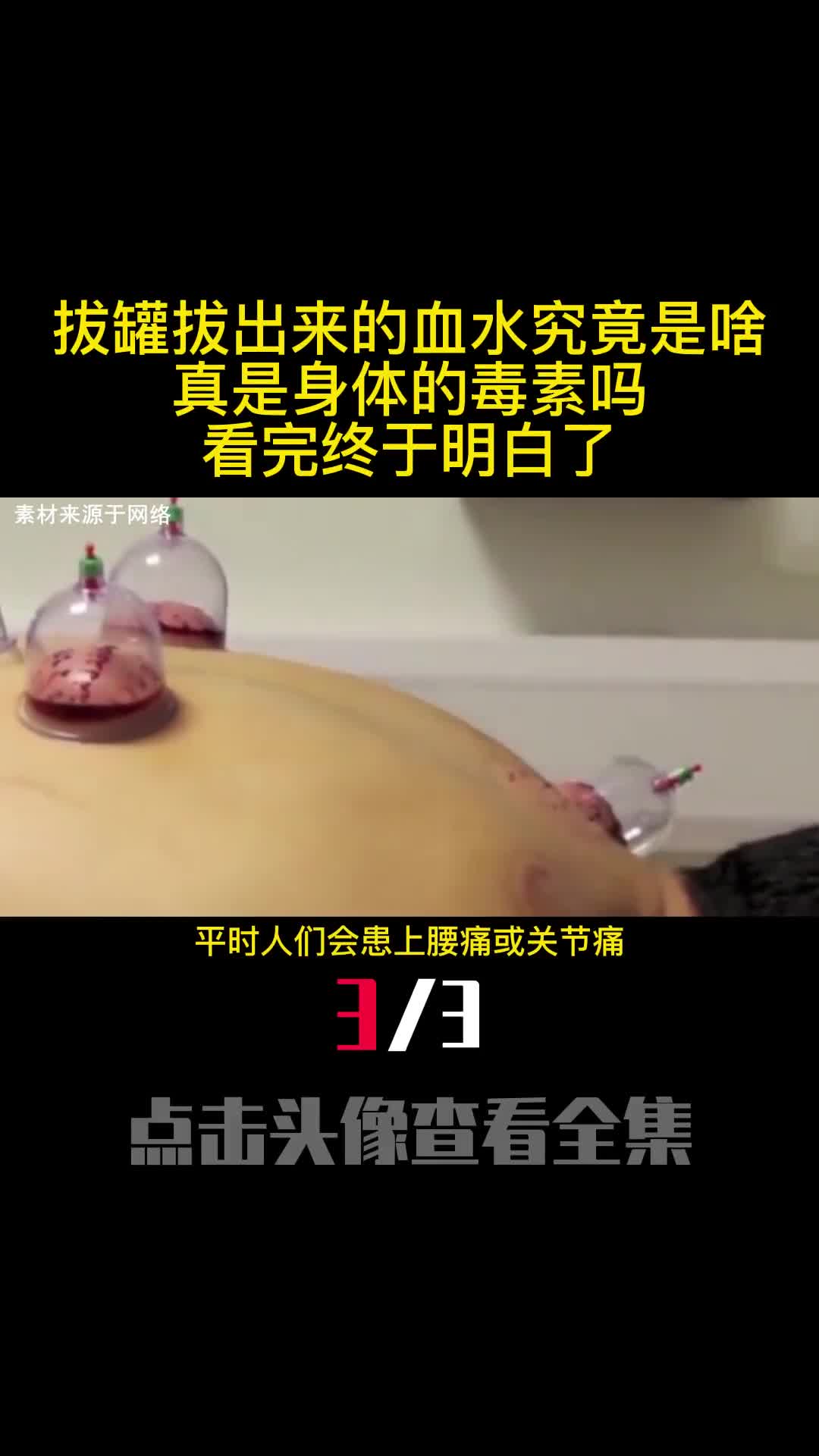 拔罐拔出来的血水究竟是啥真是身体的毒素吗看完终于明白了3