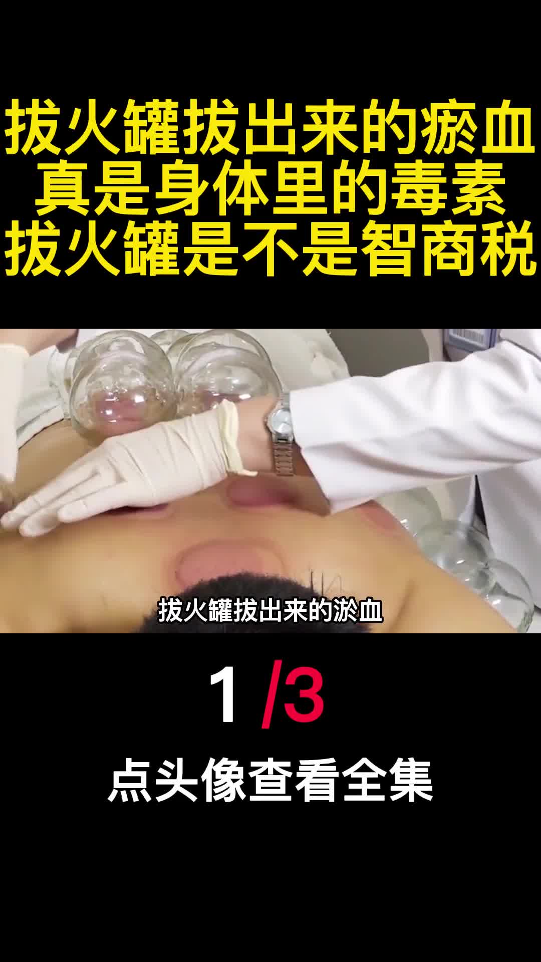 拔火罐拔出来的瘀血真是身体里的毒素拔火罐是不是智商税1