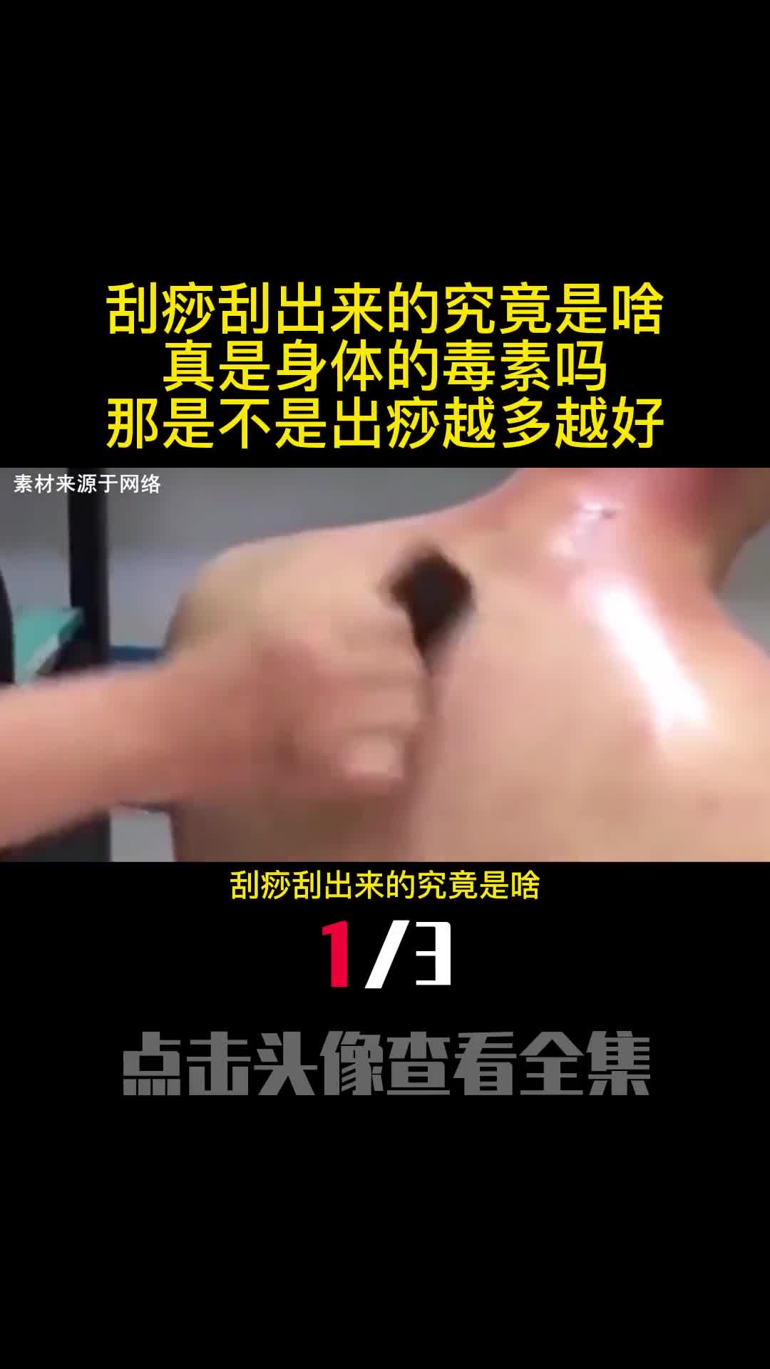 刮痧刮出来的究竟是啥真是身体的毒素吗那是不是出痧越多越好1