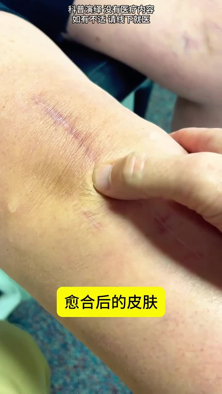 皮肤愈合后为何不能回到以前的样子