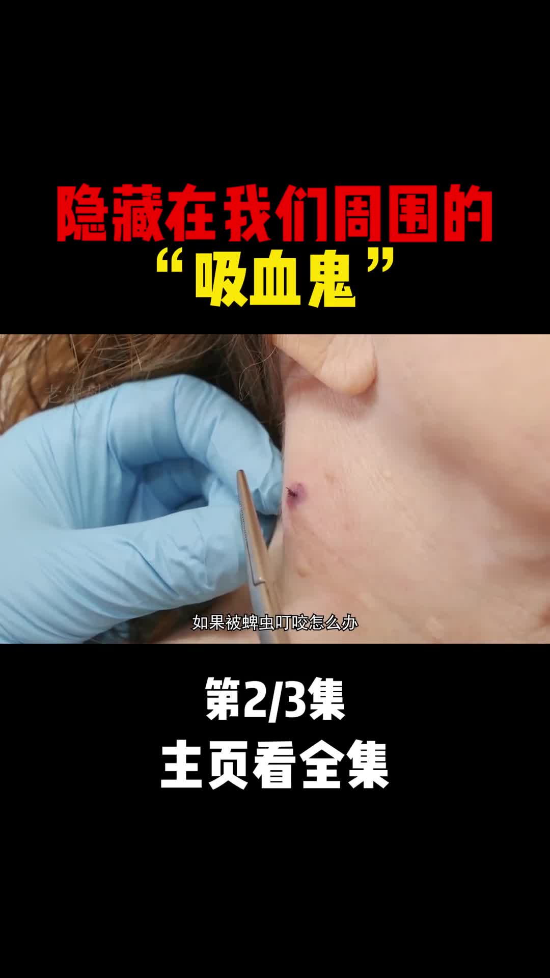 被蜱虫咬了该如何处理又该如何预防2