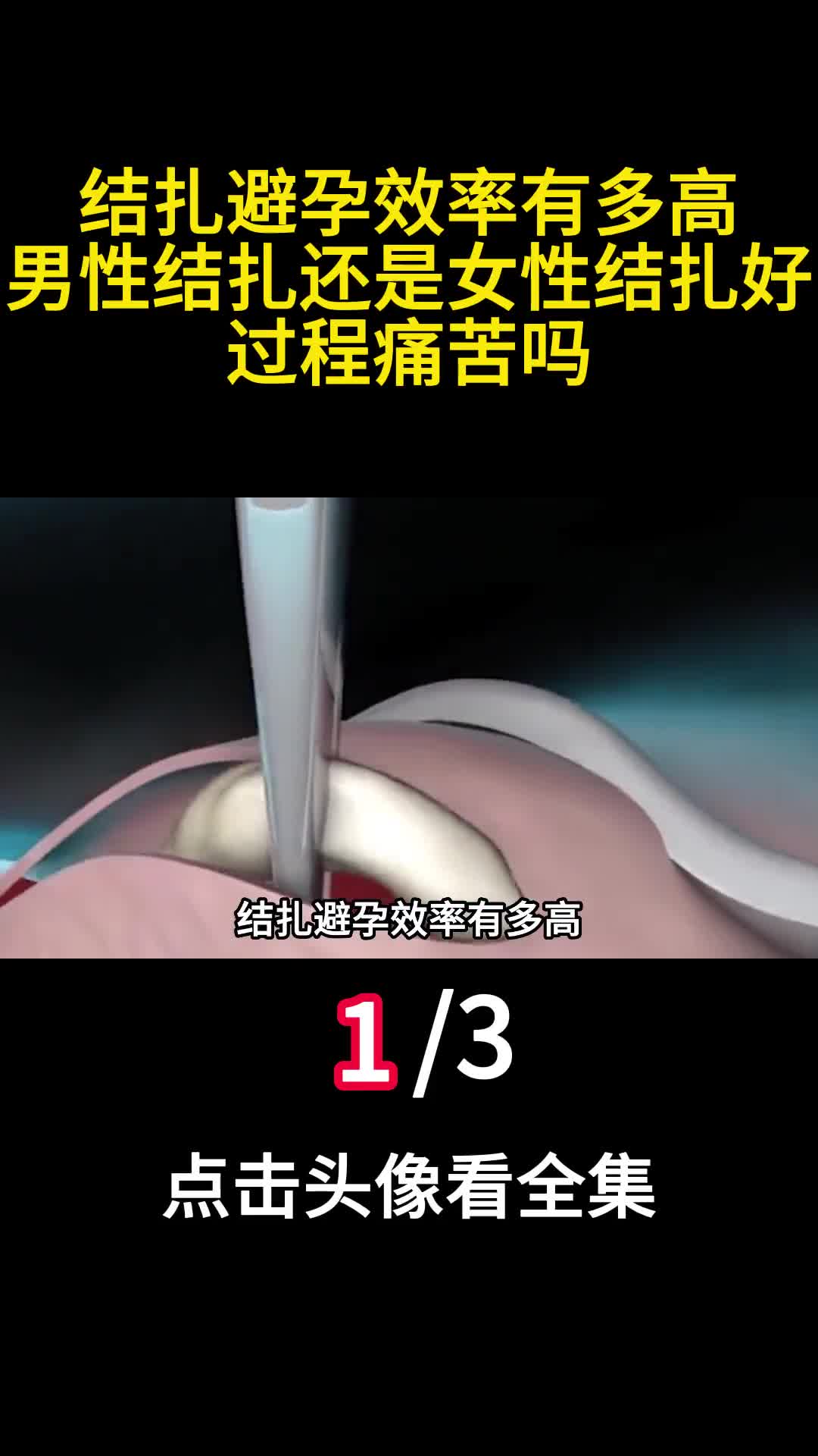 结扎避孕效率有多高男性结扎还是女性结扎好过程痛苦吗1