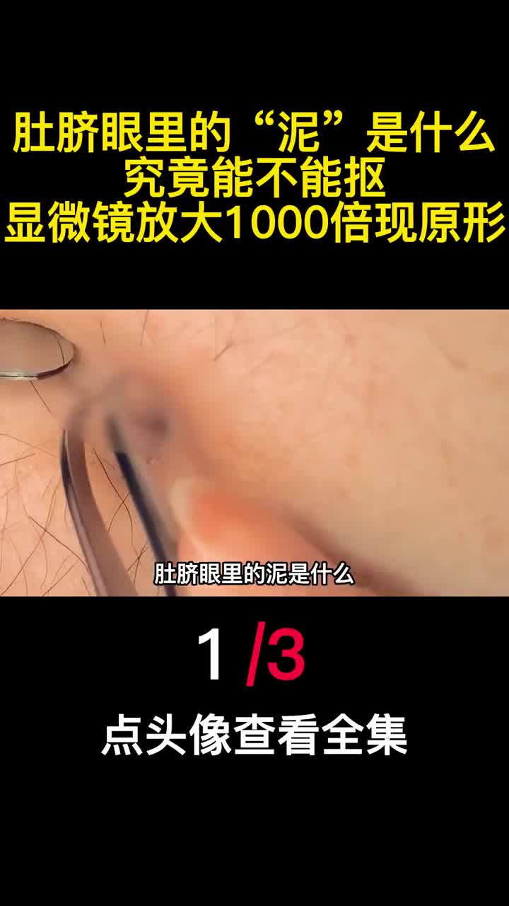 肚脐眼里的泥是什么究竟能不能抠显微镜放大1000倍现原形1