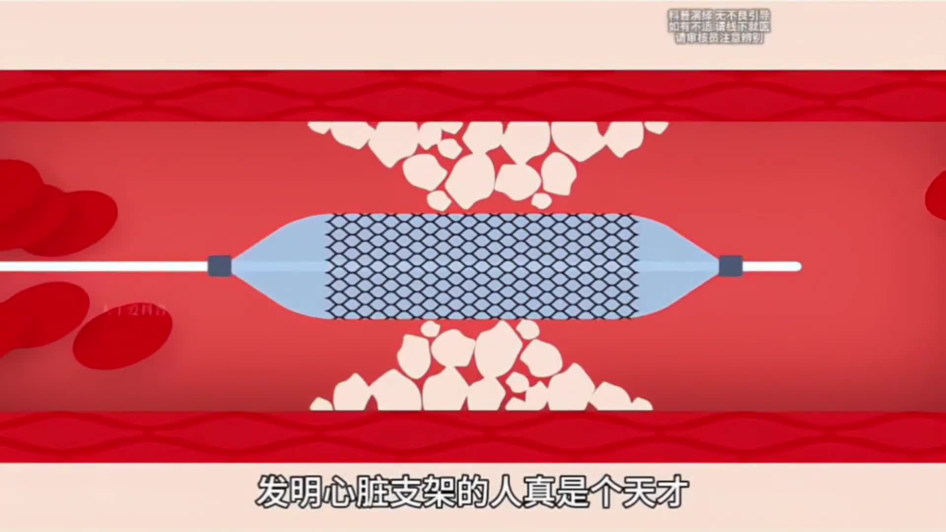 心脏支架使用原理心脏支架使用原理