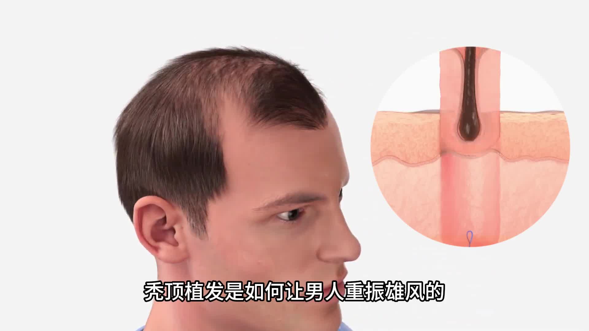秃顶植发是如何让男人重振雄风的