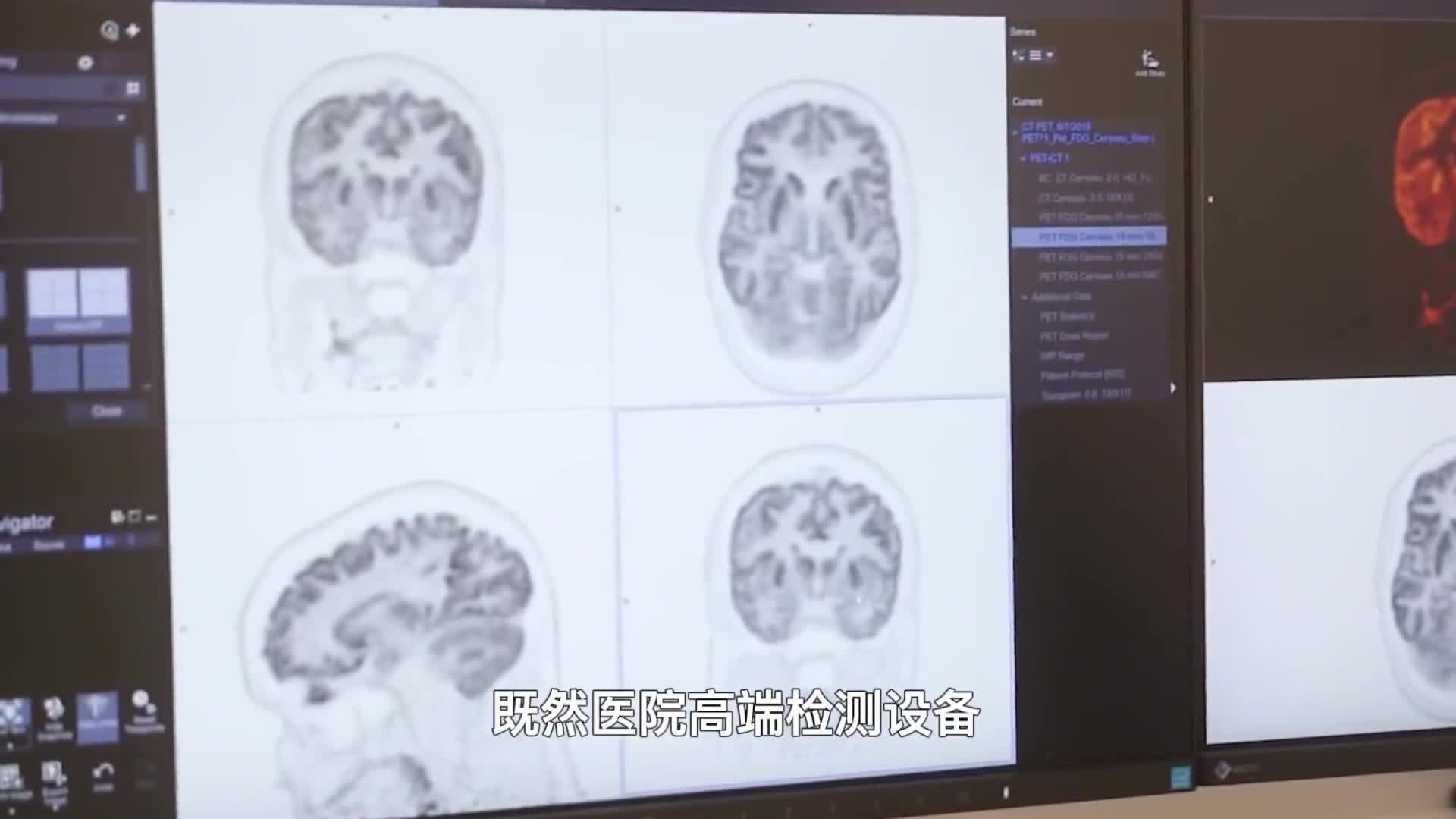 国内大型医疗设备为什么都依赖进口国产到底差在哪