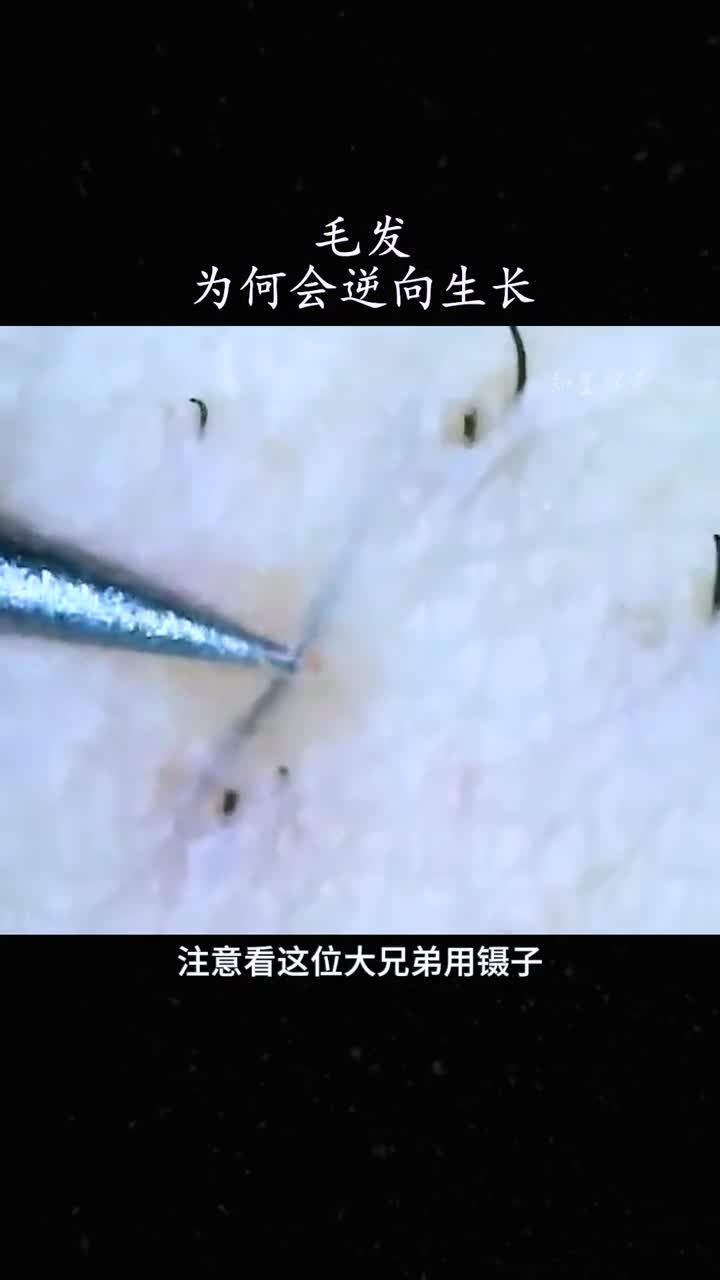逆向生长的毛发该怎么办