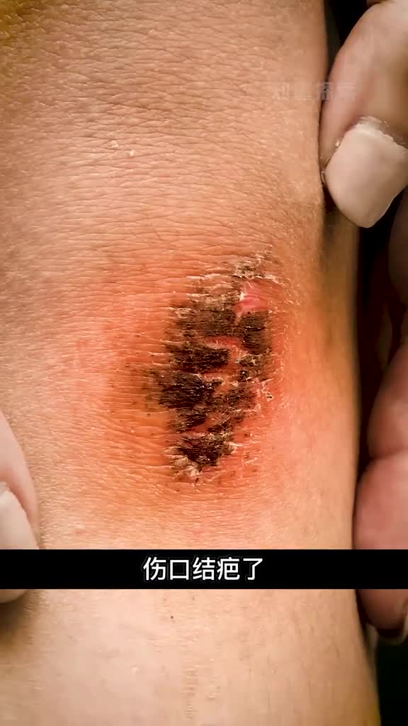伤口处的结疤抠掉会发生什么